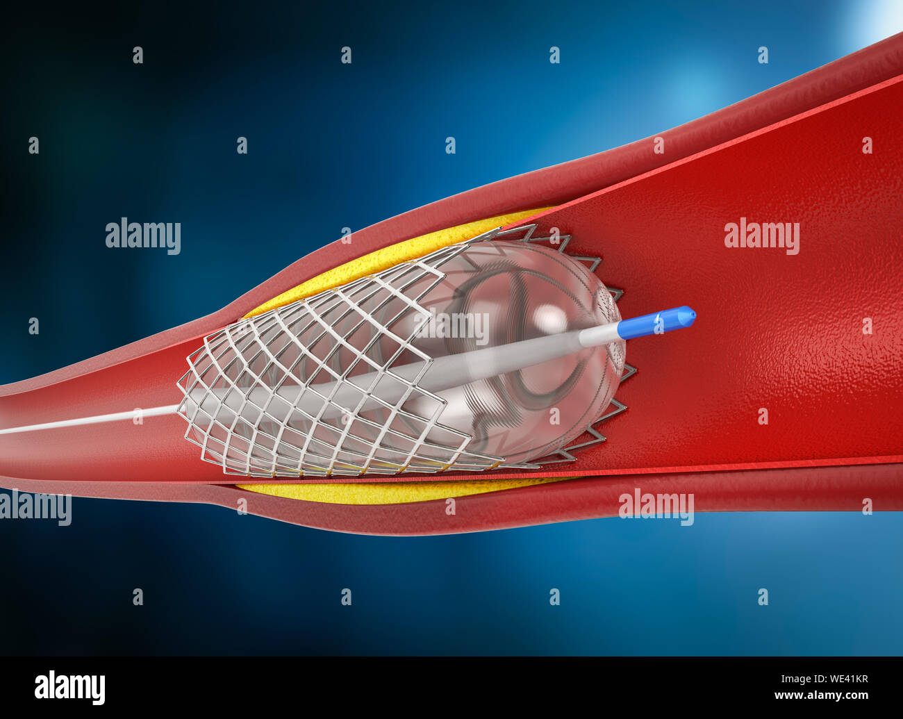 3d rendering balloon angioplasty procedure with stent in vein Stock Photo Alamy
