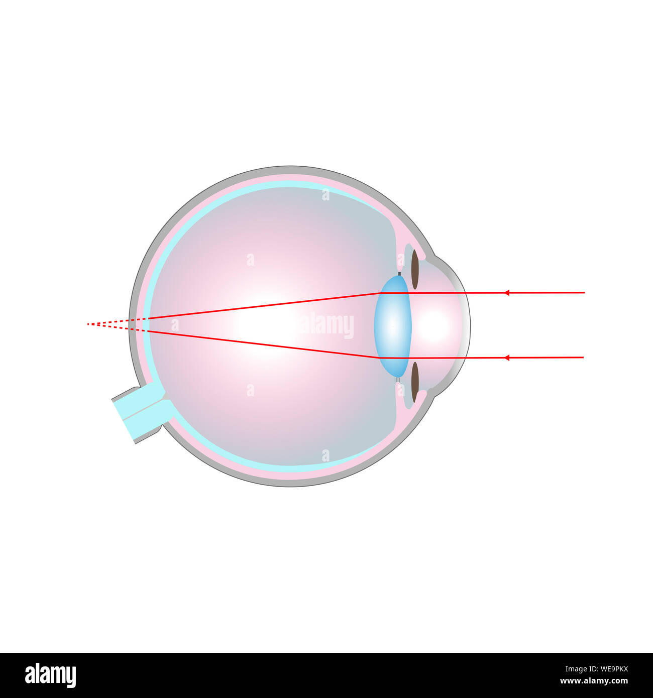 Vision disorder, illustration. Long-sightedness (hyperopia). Stock Photo