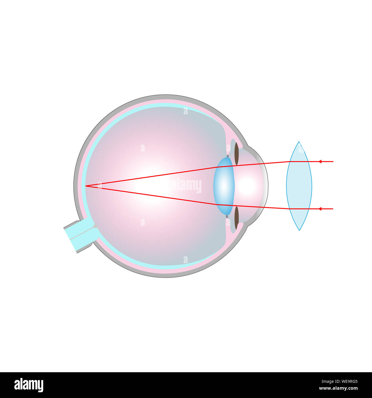 Vision disorder, illustration. Long-sightedness (hyperopia) corrected with  a convex lens Stock Photo - Alamy