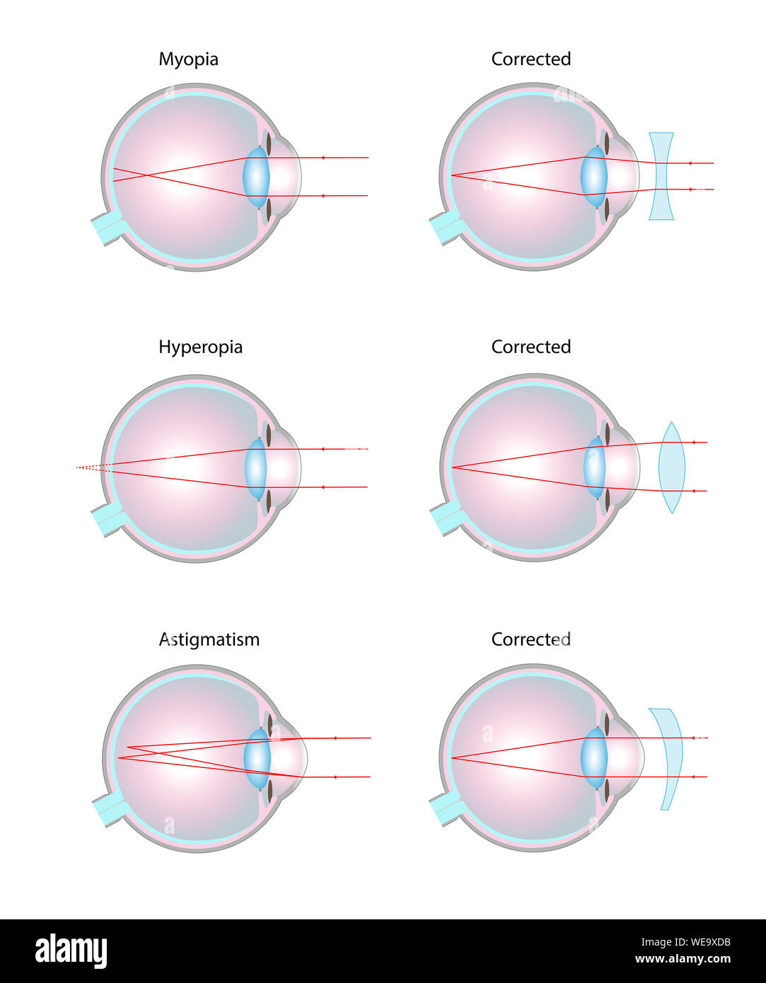 Vision disorders and corrective lenses, illustration. Short-sightedness/myopia (top), long-sightedness/hyperopia (middle), astigmatism (bottom). Stock Photo