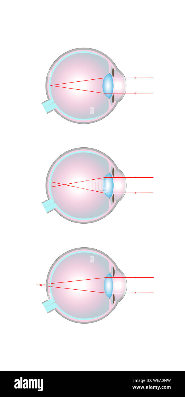 Human eye, normal vision (top), myopia or short-sightedness (middle) and hyperopia or long-sightedness (bottom). Stock Photo