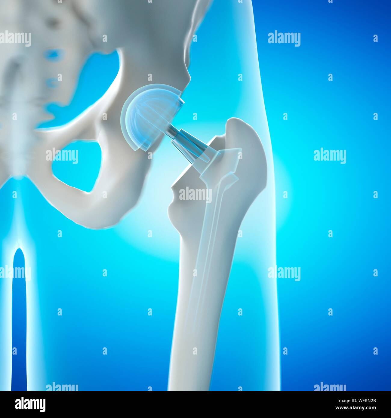 Hip replacement, illustration Stock Photo