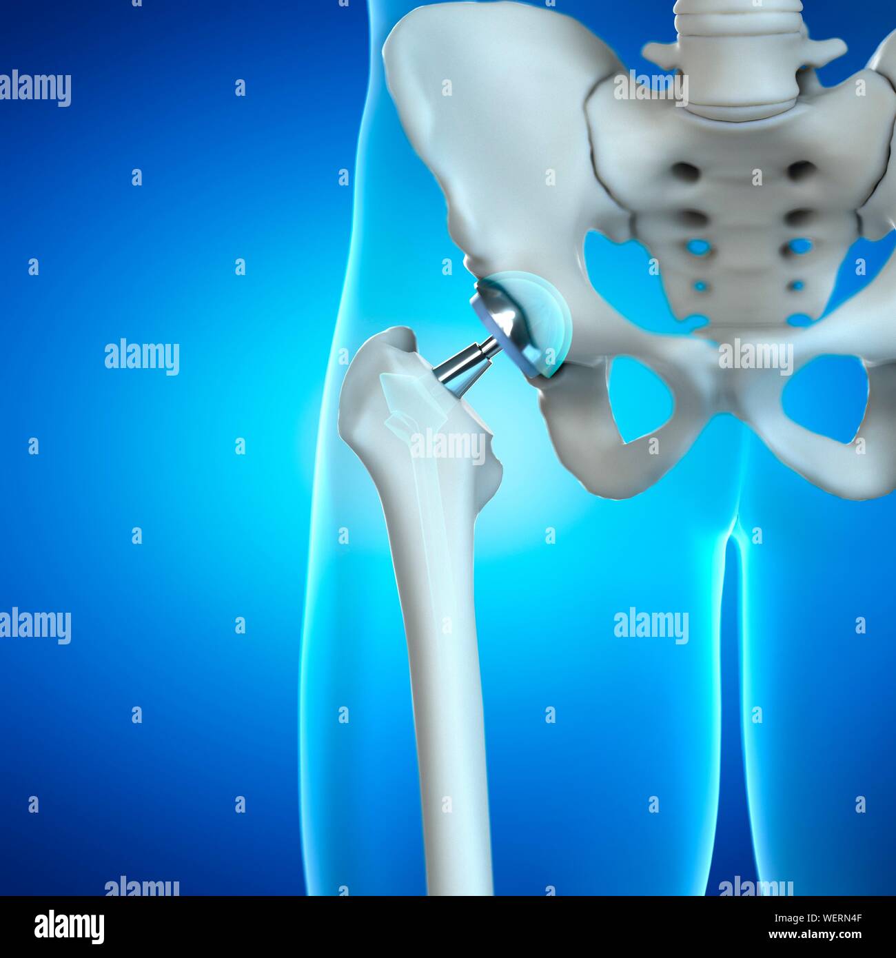 Hip replacement, illustration Stock Photo