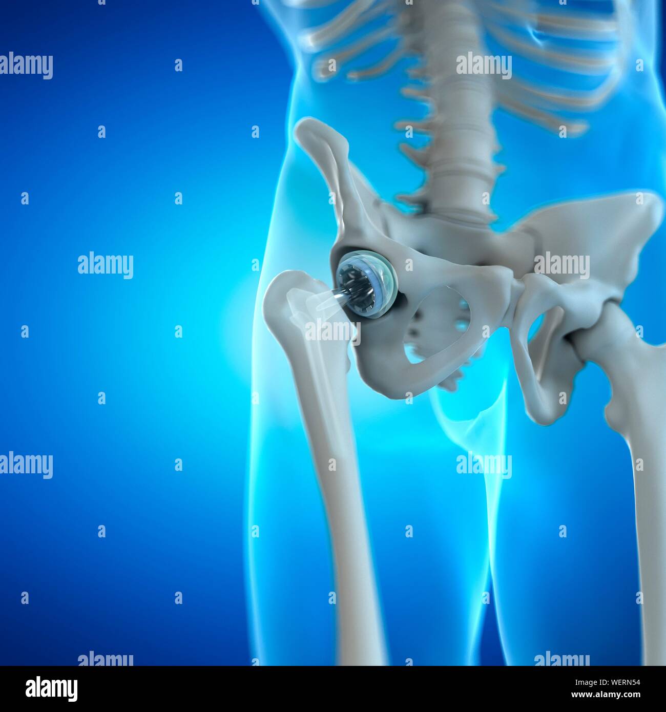 Hip replacement, illustration Stock Photo Alamy
