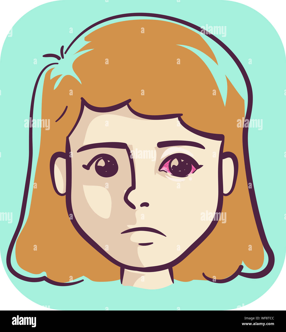 Illustration of Girl with Pink Eye, a Gonorrhea Symptom Stock Photo Alamy