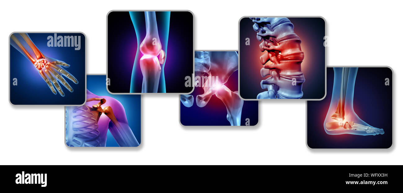 Pain of the joints concept as skeleton and muscle anatomy of the body with a group of sore joints as a painful injury or arthritis illness symbol for Stock Photo
