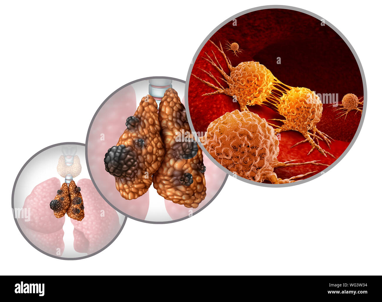 Thymus cancer disease or thymoma and thymic carcinoma illness as a gland anatomy sickness with growing malignant mutating cell growth as an icon. Stock Photo