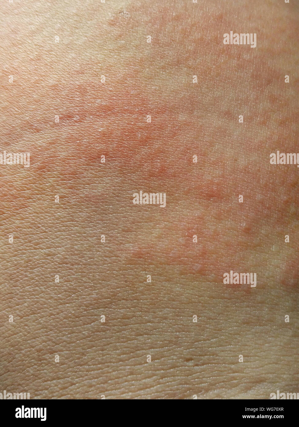 Extreme Close-up Of Allergic Skin Stock Photo