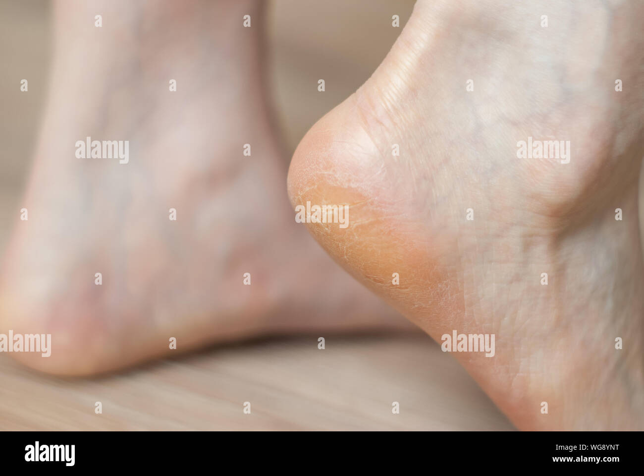 clavus and cracks on the heel of female foot close-up Stock Photo