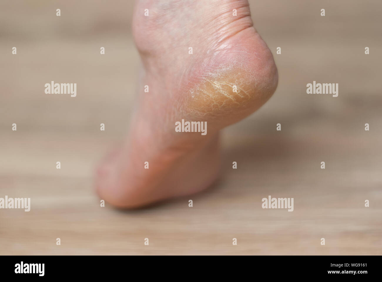 clavus and cracks on the heel of female foot close-up Stock Photo