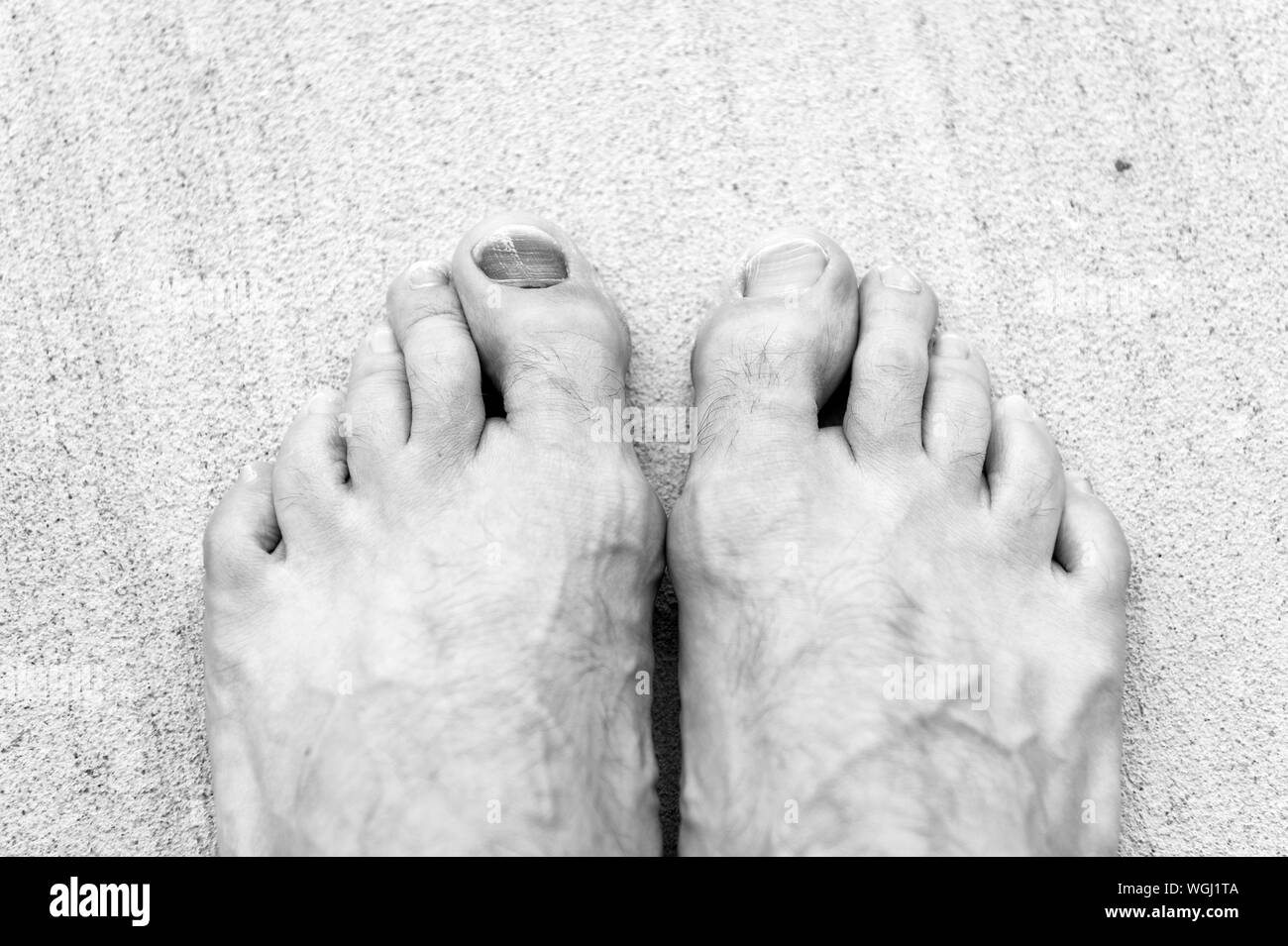 Take care of your feet. Pedicure and podiatry. Treatment of bruise and