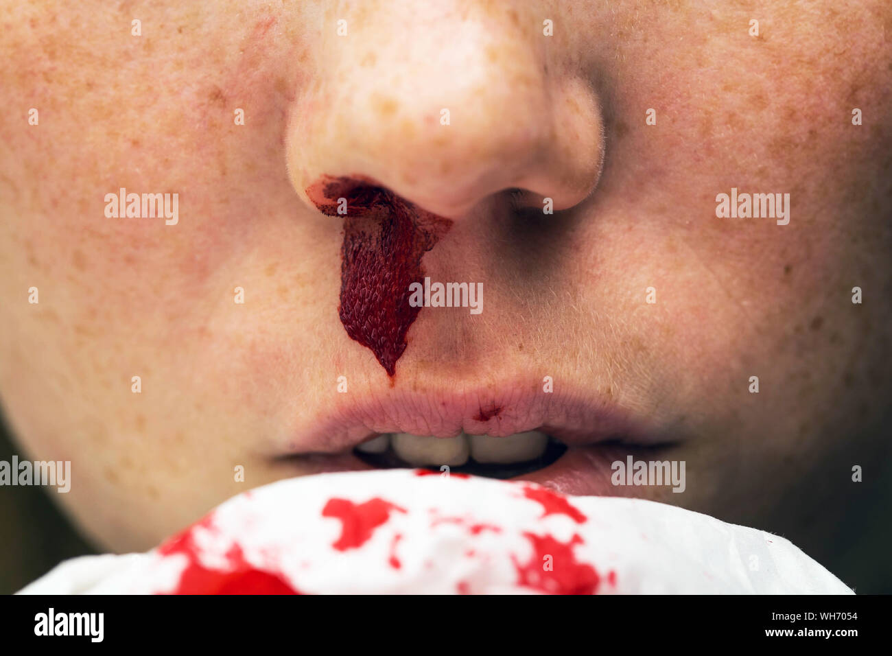 Wound nosebleed, woman bleeding from her nose, nose injury blood and tissue Stock Photo