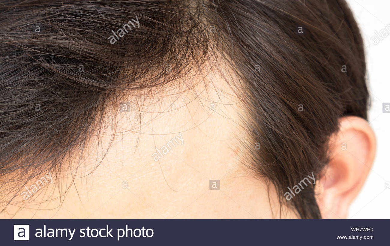 Receding Hairline Stock Photos Receding Hairline Stock Images