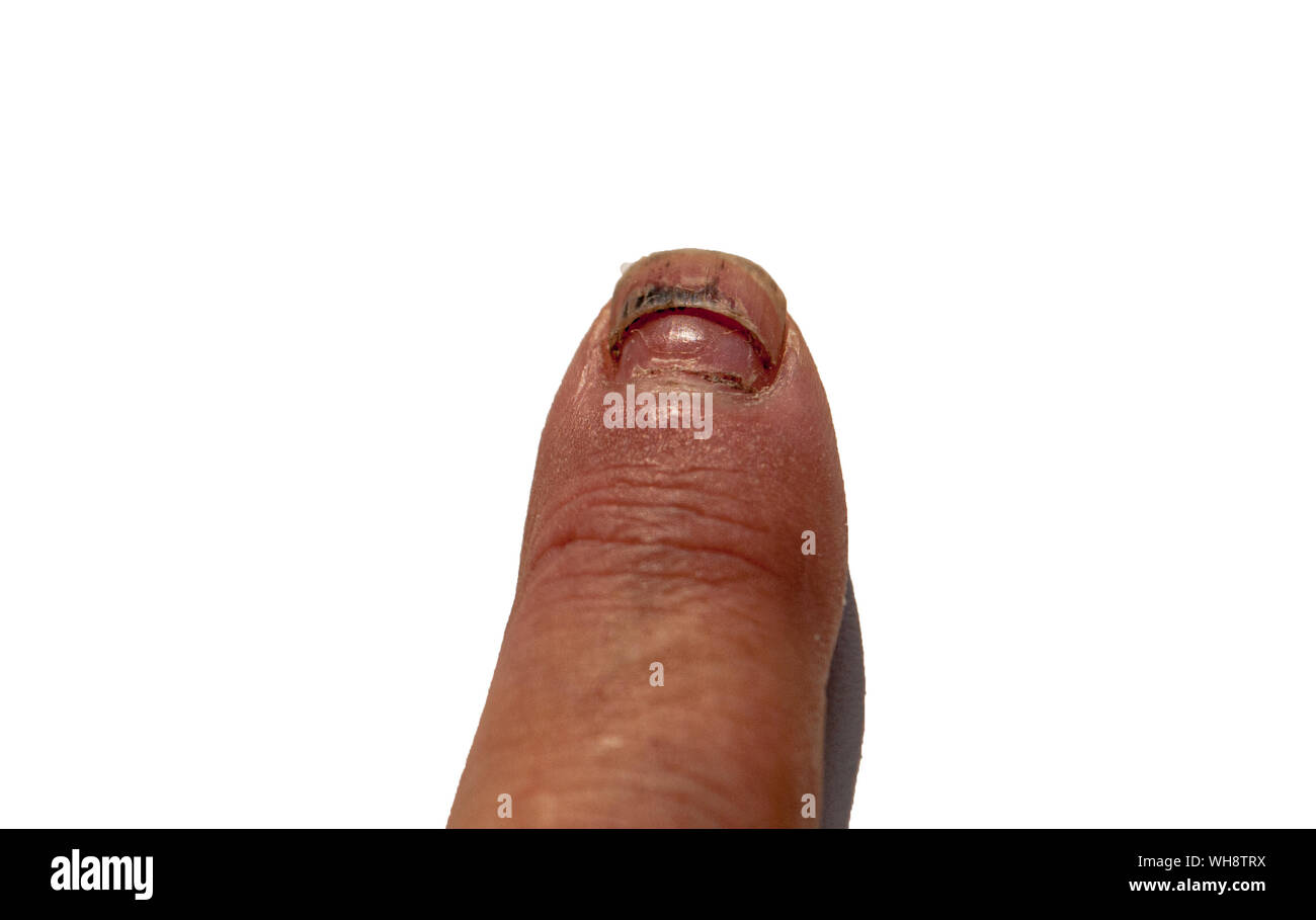 injured index finger and dying nail isolated on white background Stock