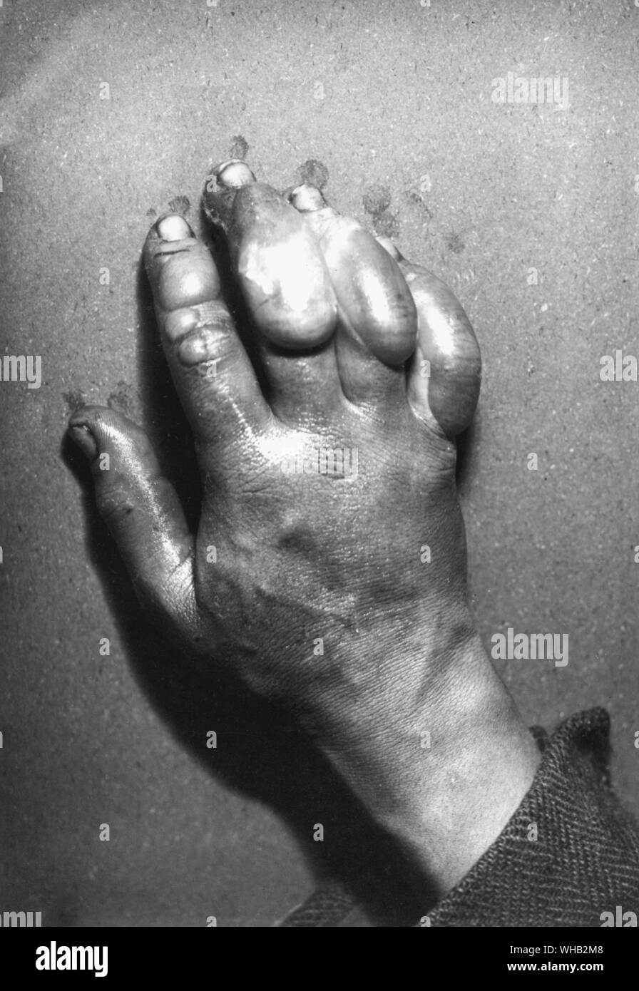 Dr Atkinson's frost-bitten hand July 5th 1911 Stock Photo