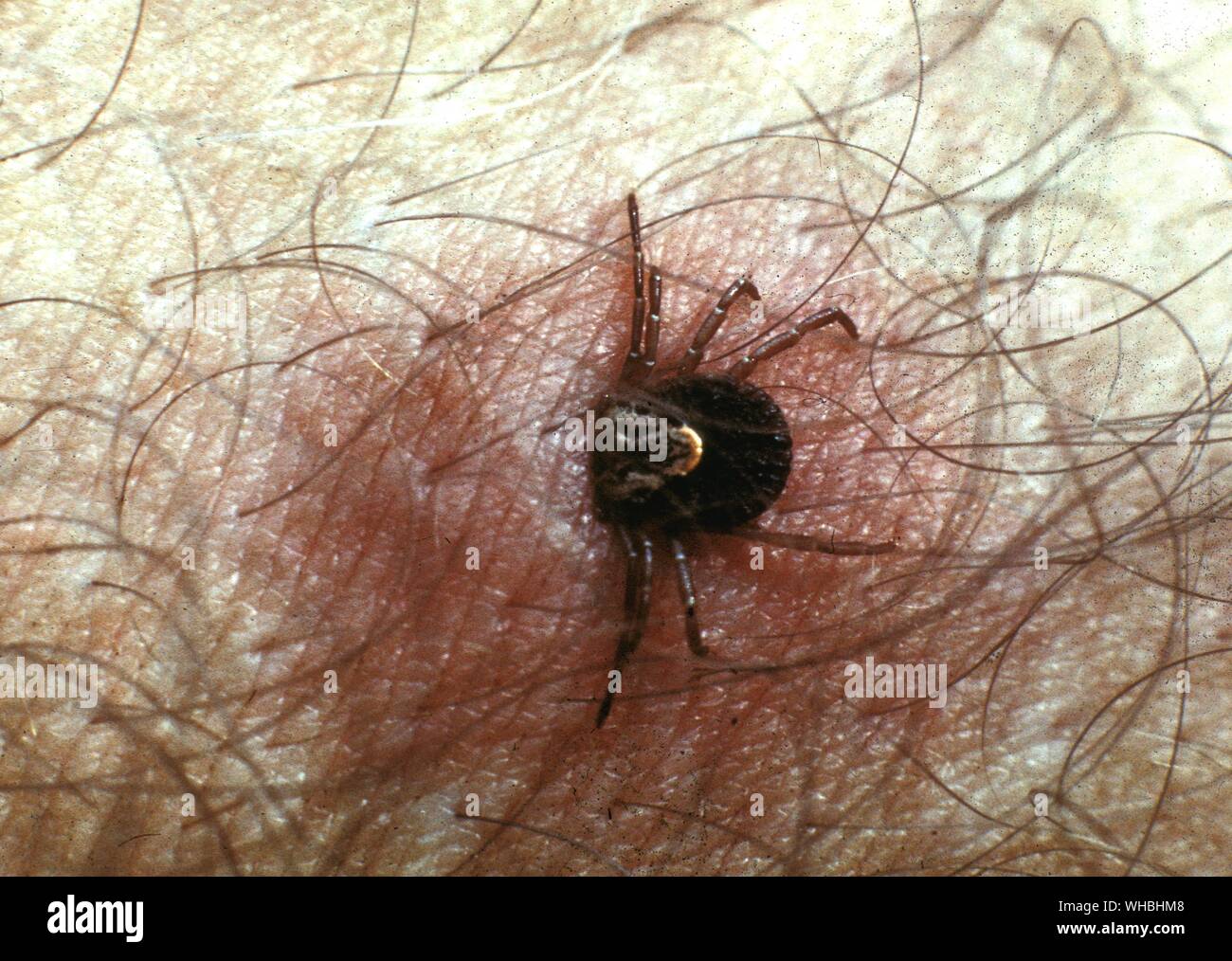 Microscopic view of a tick on a human arm , Brazil Stock Photo