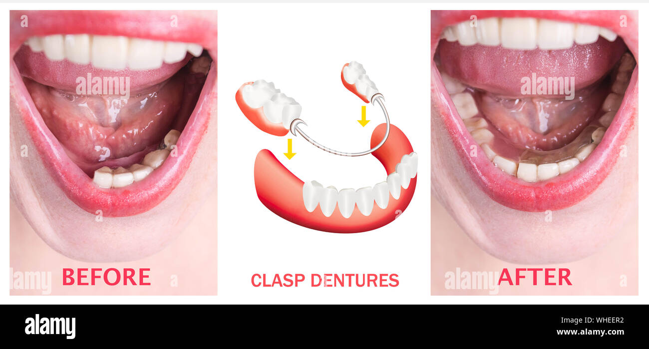 Dental rehabilitation with upper and lower prosthesis, before and after