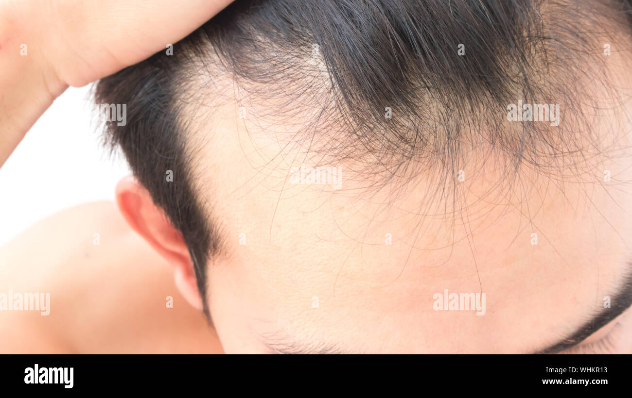 High Section Of Man With Receding Hairline Stock Photo