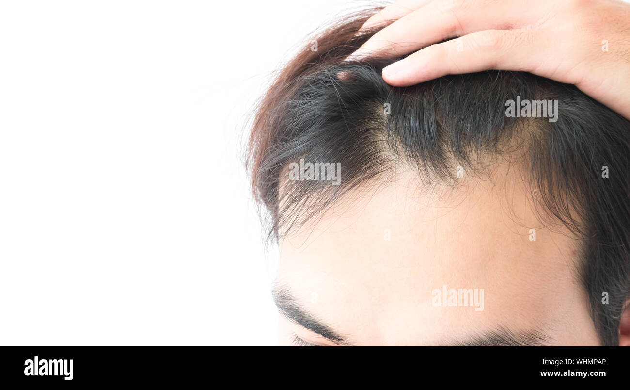 High Section Of Man With Hair Loss Problem Against White