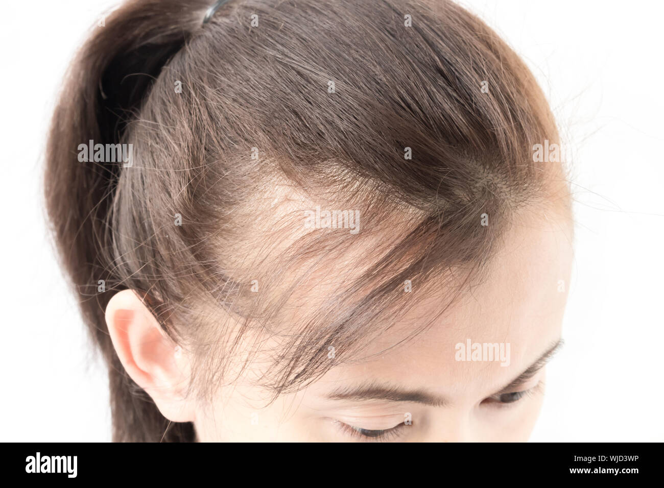 Close-up Of Young Woman With Receding Hairline Against White Background  Stock Photo - Alamy