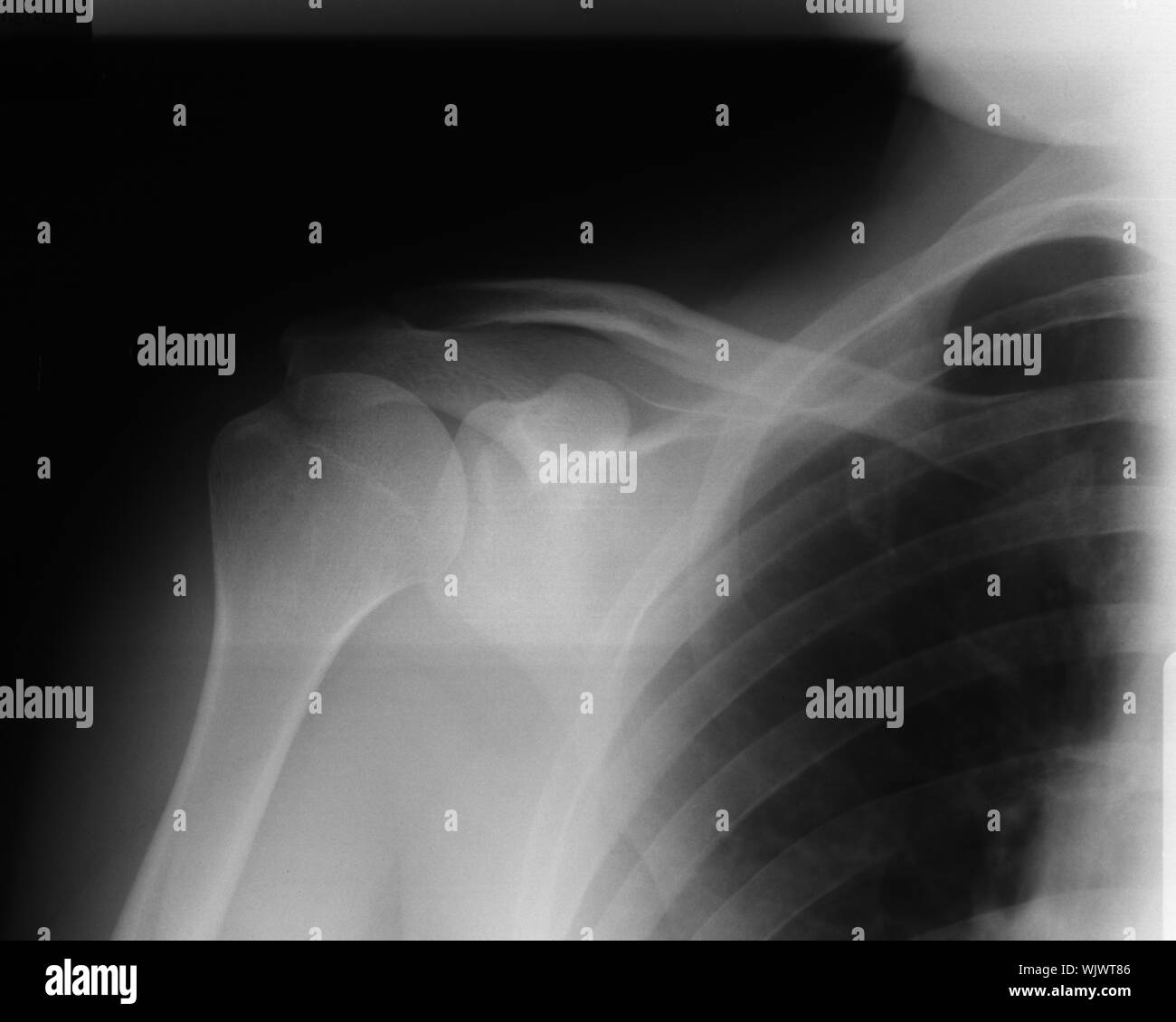 Shoulder X Ray Image High Resolution Stock Photography and Images Alamy