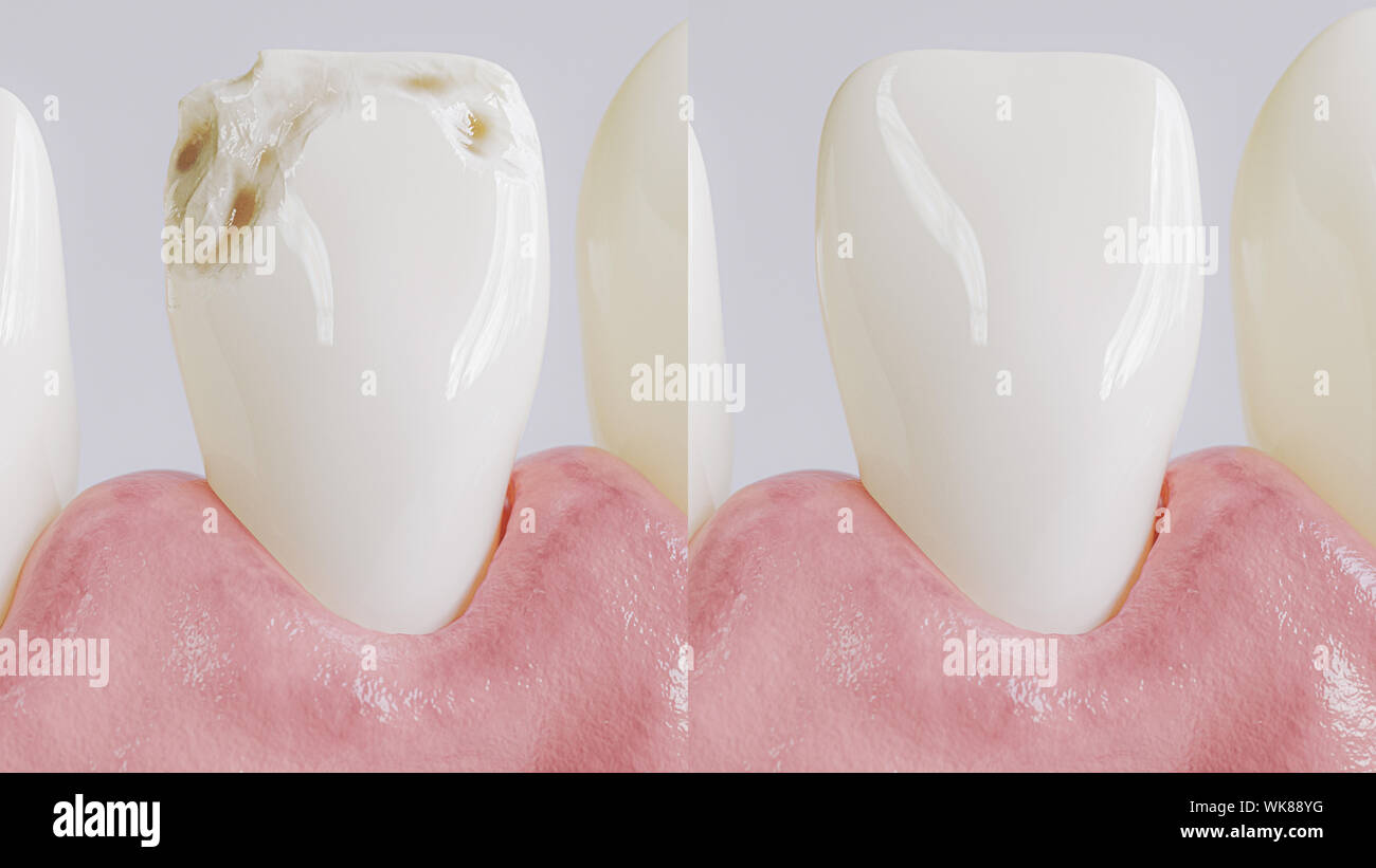 Tooth after caries treatment as closeup- 3D rendering Stock Photo
