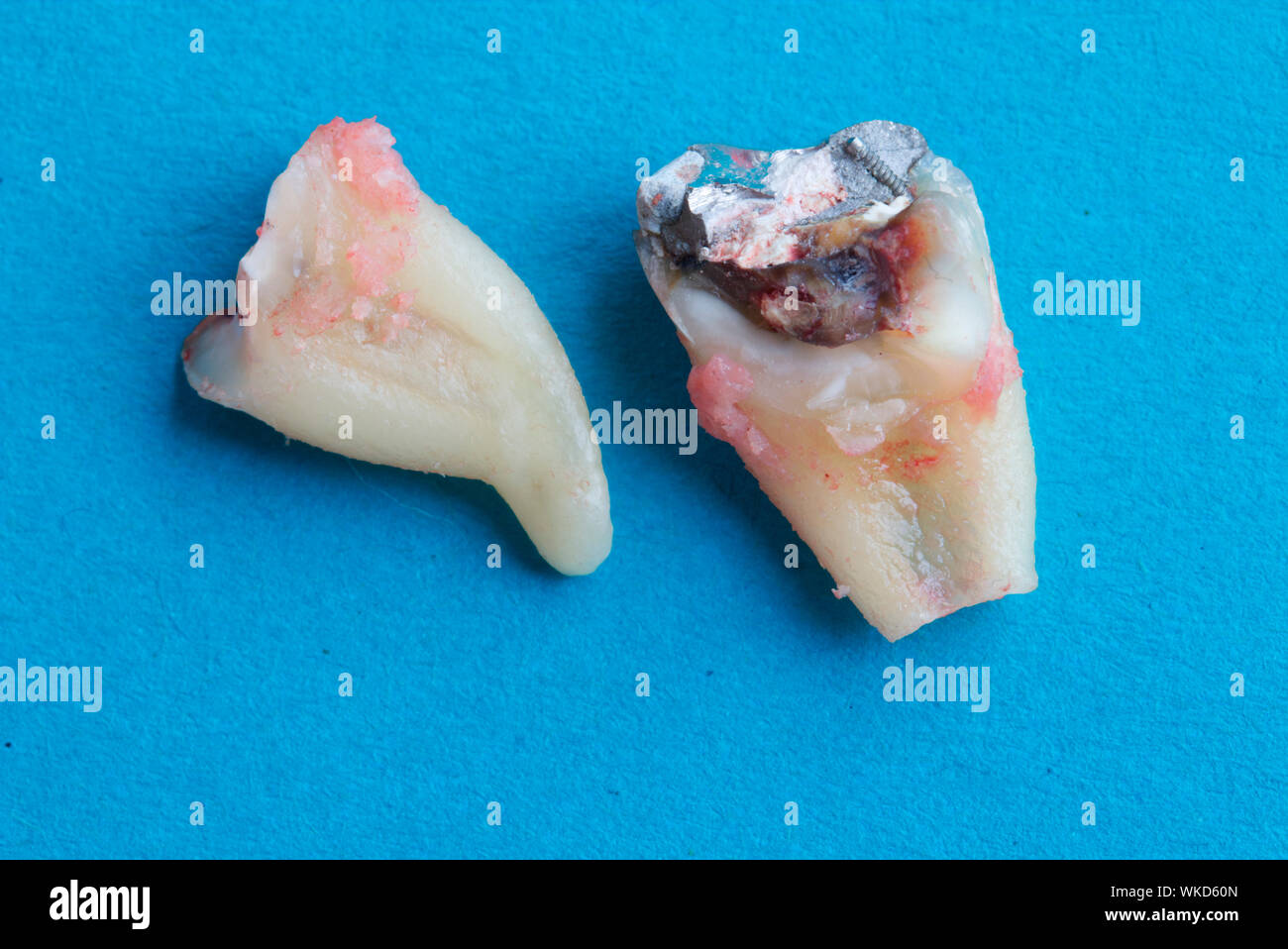 Broken molar hires stock photography and images Alamy