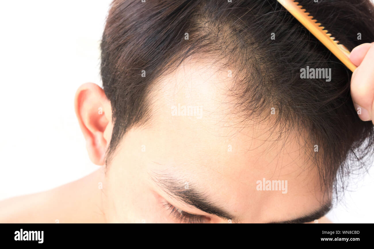 Receding Hair Stock Photos Receding Hair Stock Images Alamy