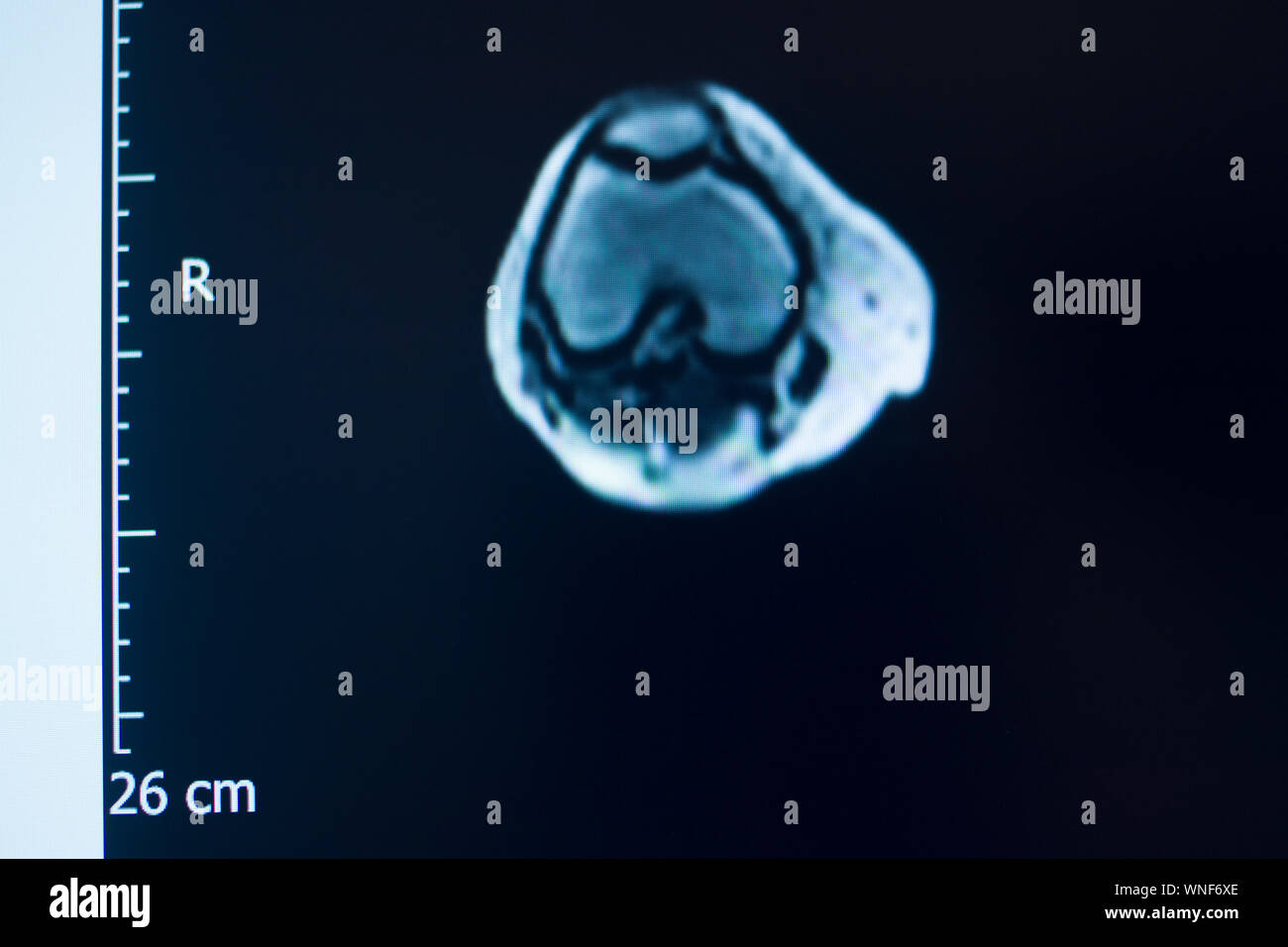 Knee sports injury mri mcl grade 2 tear resonance imaging
