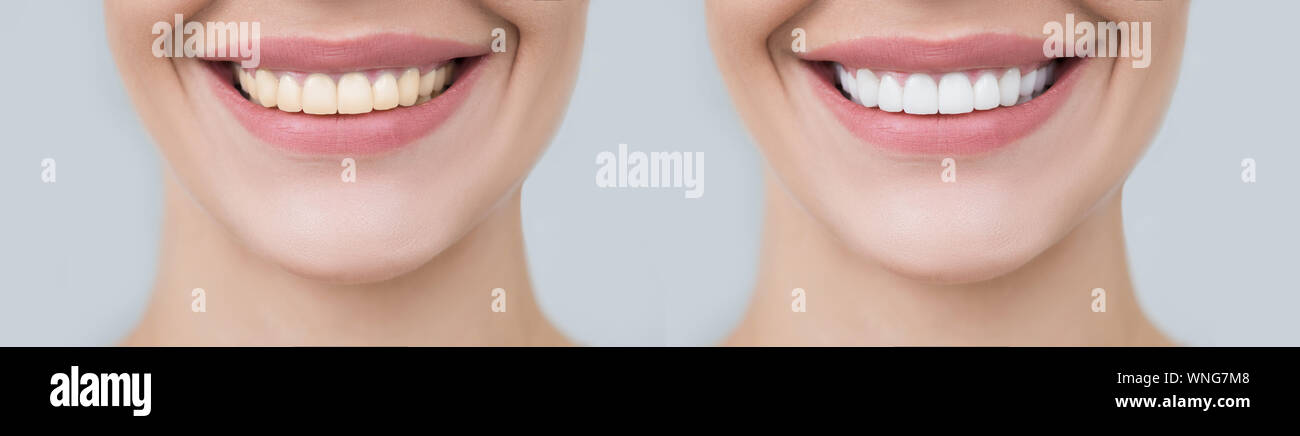 Collage female smile before and after teeth whitening. Advertising procedure whitening smile Stock Photo