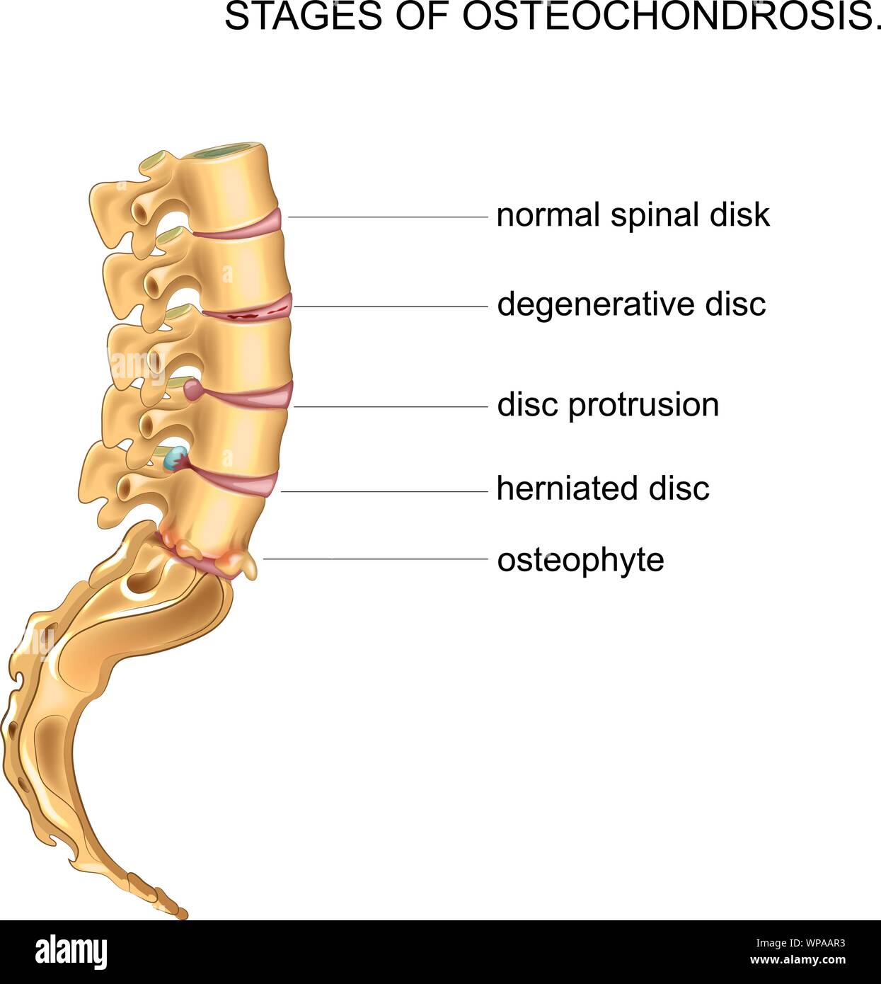 vector illustration of lumbar sacral spine and the stages of degenerative disc disease Stock Vector