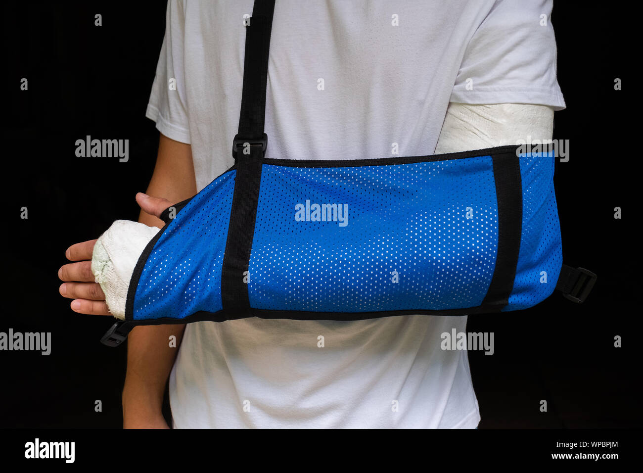 Broken Ulna High Resolution Stock Photography and Images Alamy