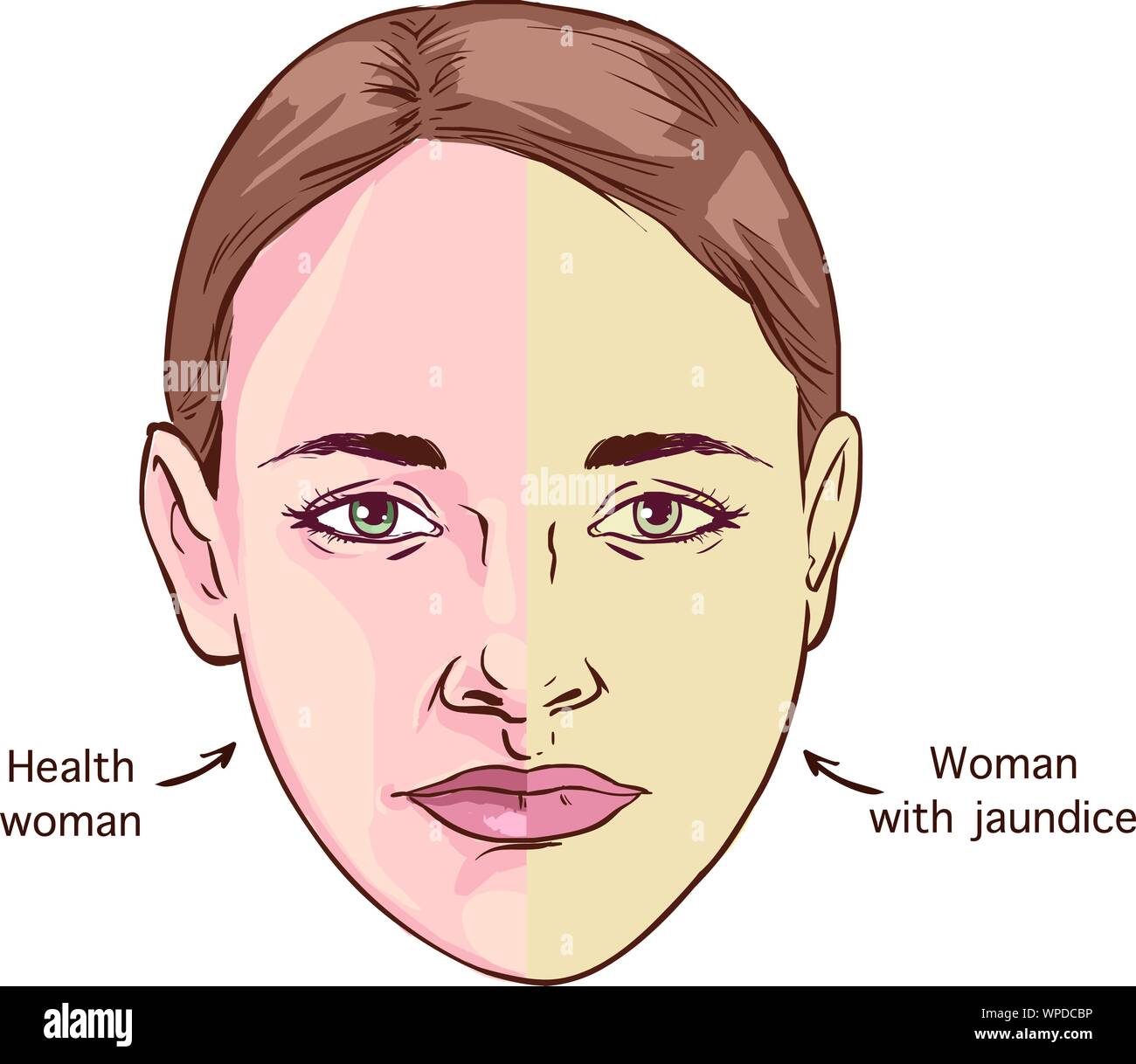 Jaundice vector images, illustrations, and clip art Stock Vector