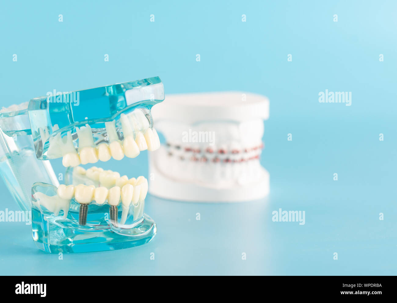 Dental implant model on blue background Stock Photo - Alamy