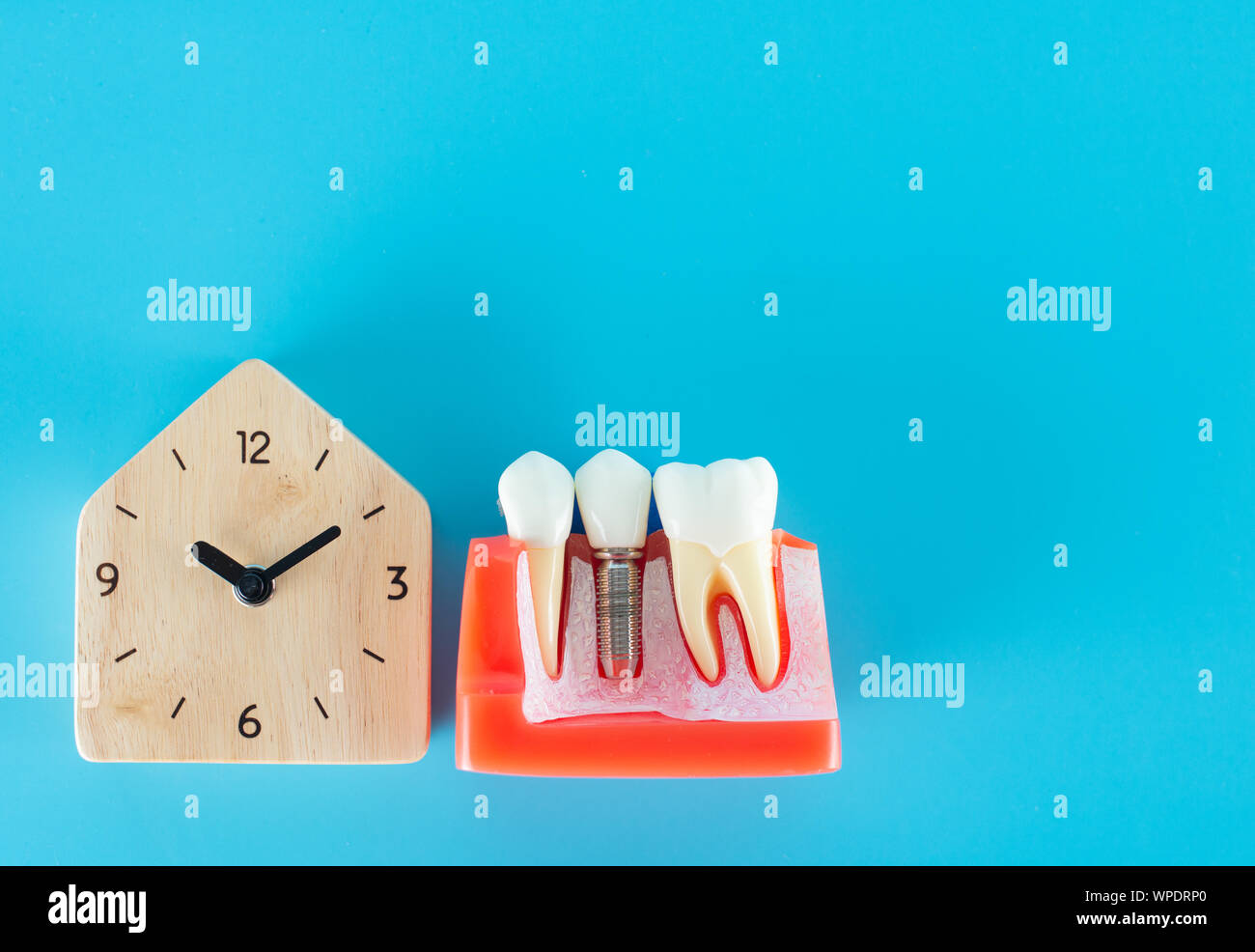 Wooden clock with dental implant model on blue background in dental