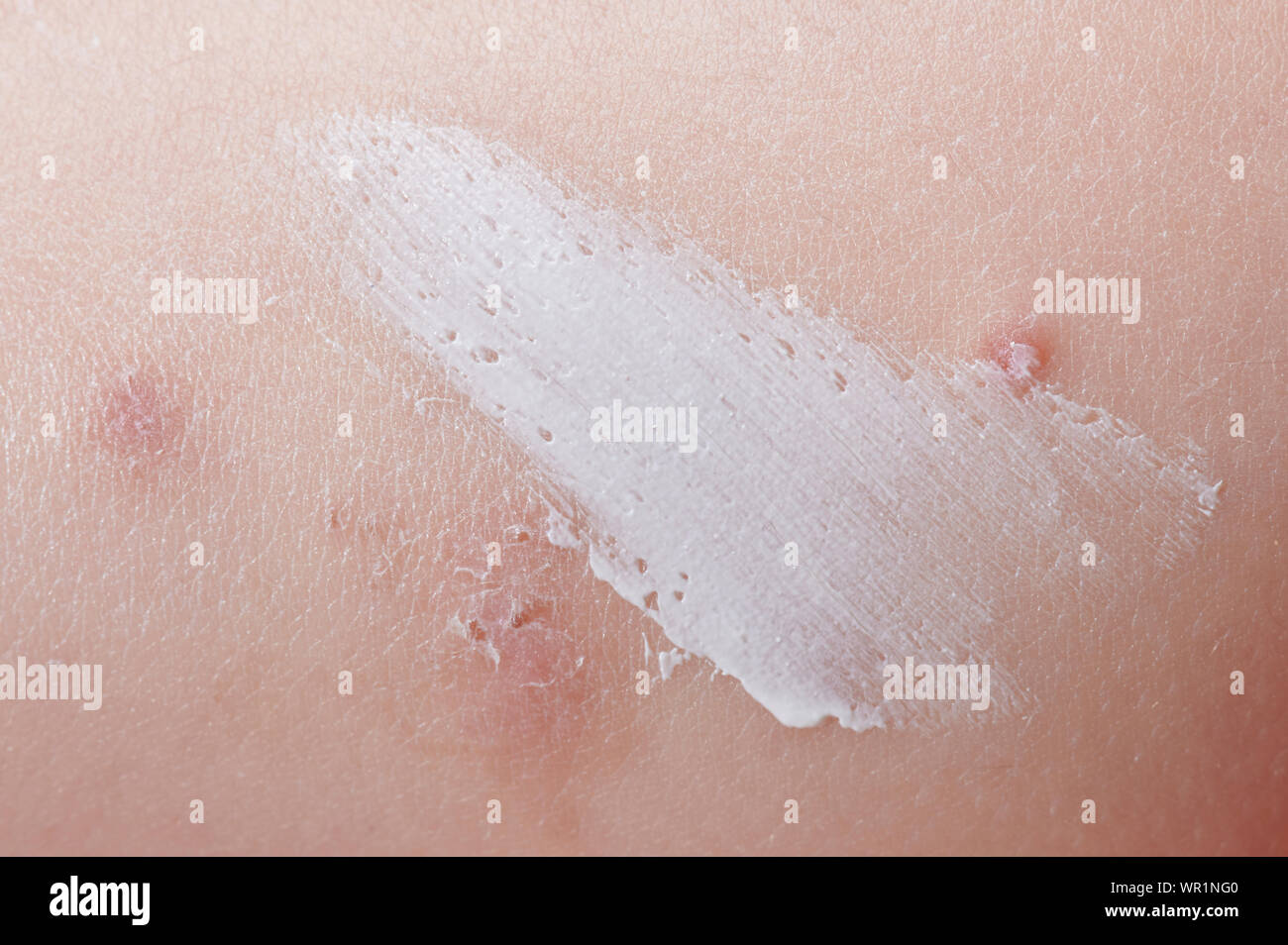 Applying cream on skin scar close up view. Treatment of skin problem Stock Photo