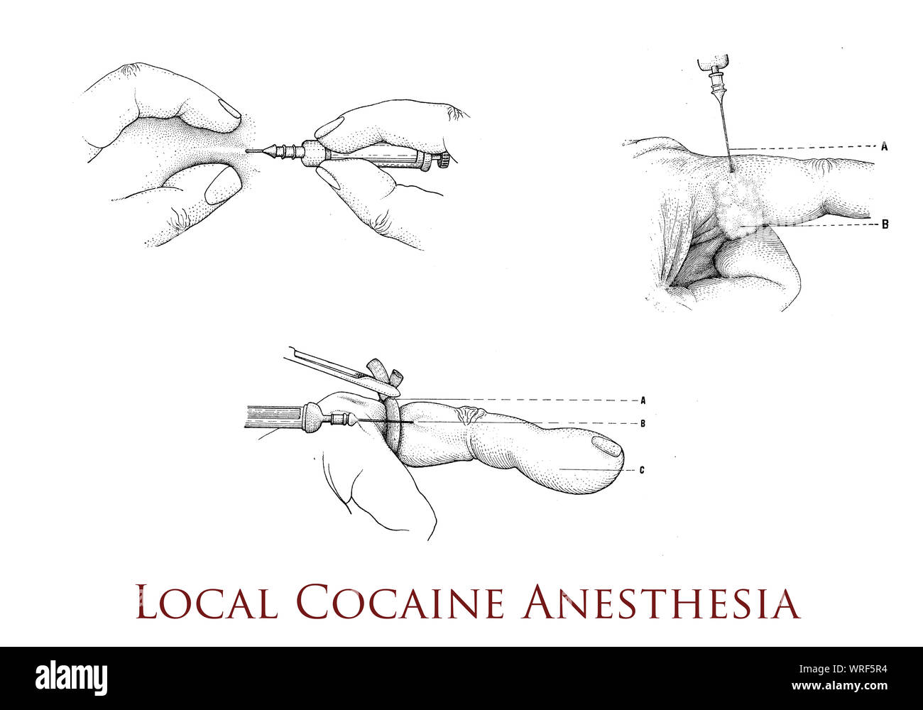 Analgesia High Resolution Stock Photography and Images Alamy