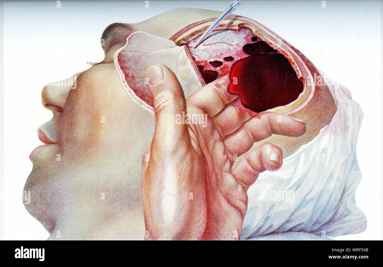 Intercranial hematome.Surgical treatment of the intracranial hemorrhage:the intracranial bleeding increases the skull internal pressure damaging the brain tissues. Stock Photo