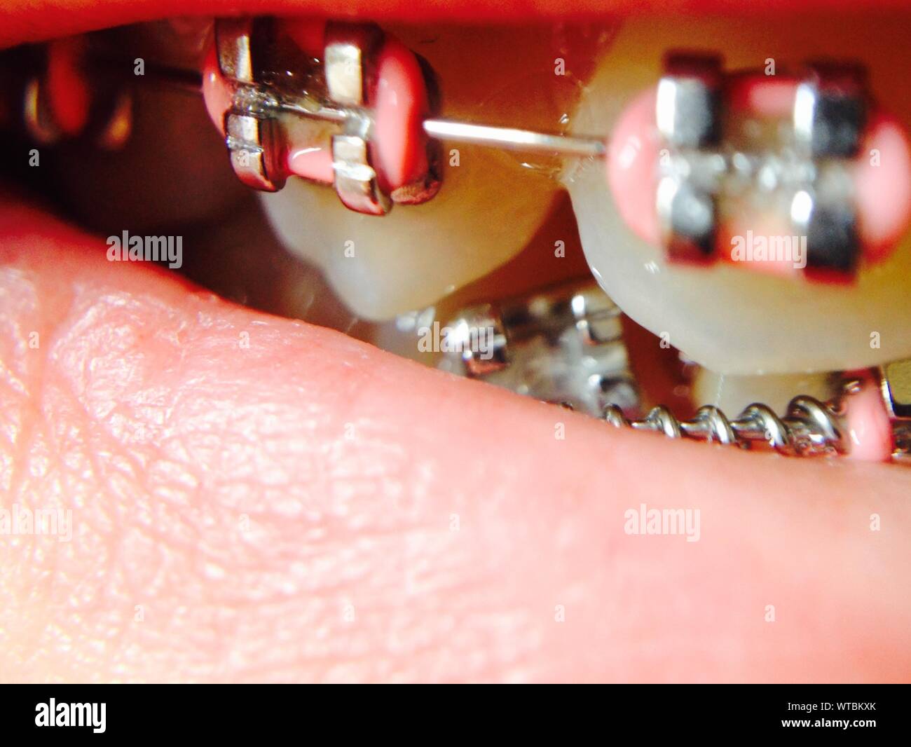 Metal braces teeth hi-res stock photography and images - Alamy