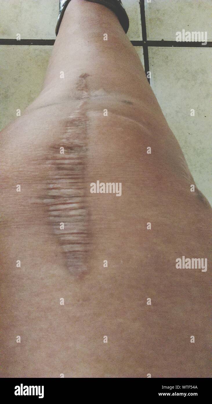 Leg Stitches High Resolution Stock Photography and Images Alamy