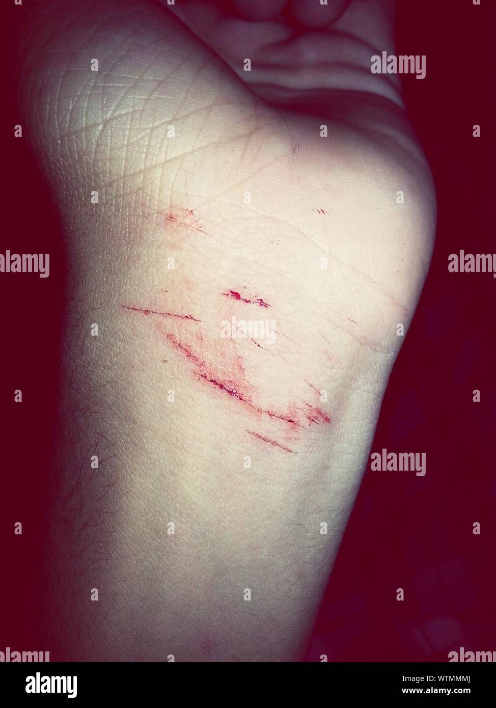 Bruise And Leg Stock Photos & Bruise And Leg Stock Images Alamy