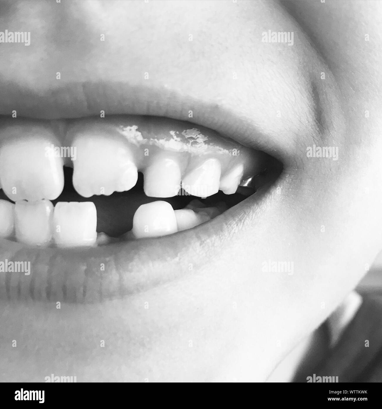 Close-up Of Child Losing Milk Teeth Stock Photo