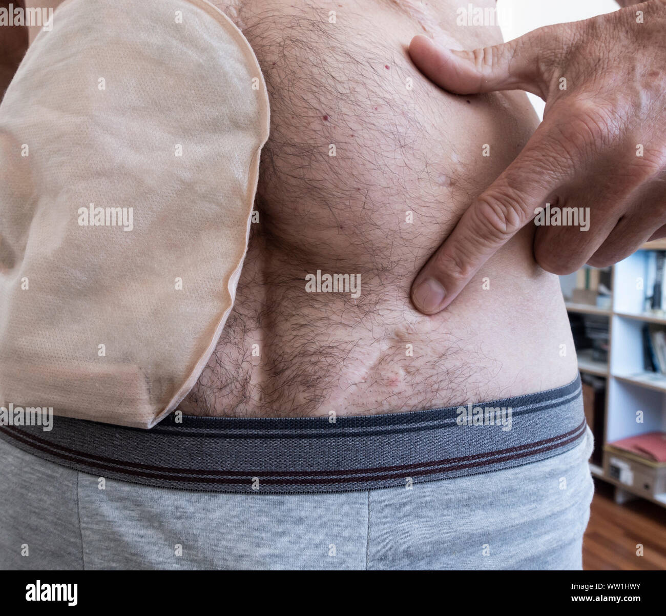 60 year old male wearing ileostomy bag points to scar on left lower abdomen, the result of an operation to remove a testicle (orchiectomy) in 1979 Stock Photo