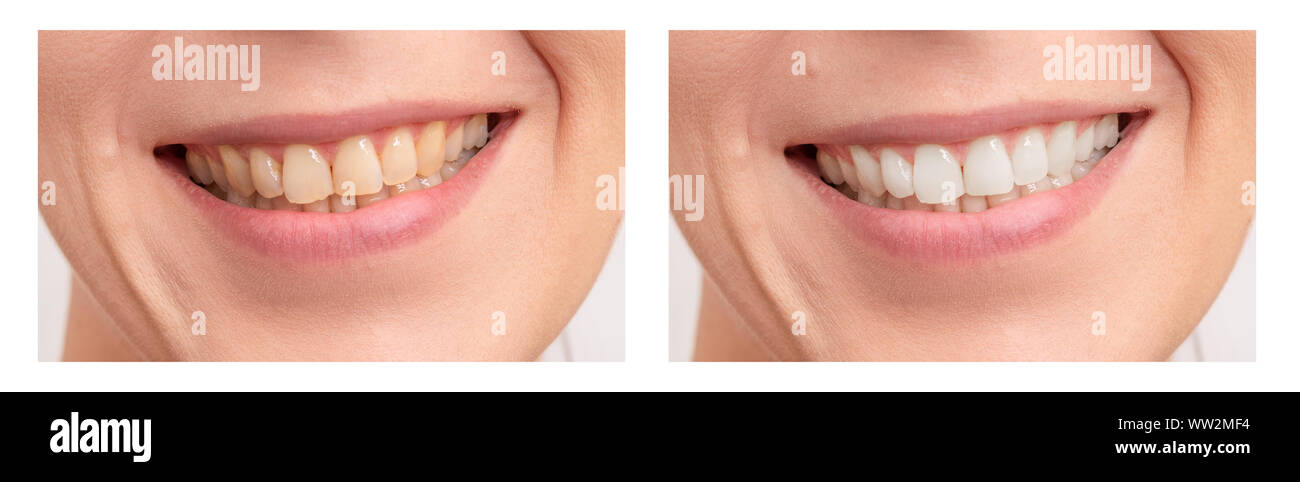 Close up of female mouth. Comparison after teeth whitening Stock Photo