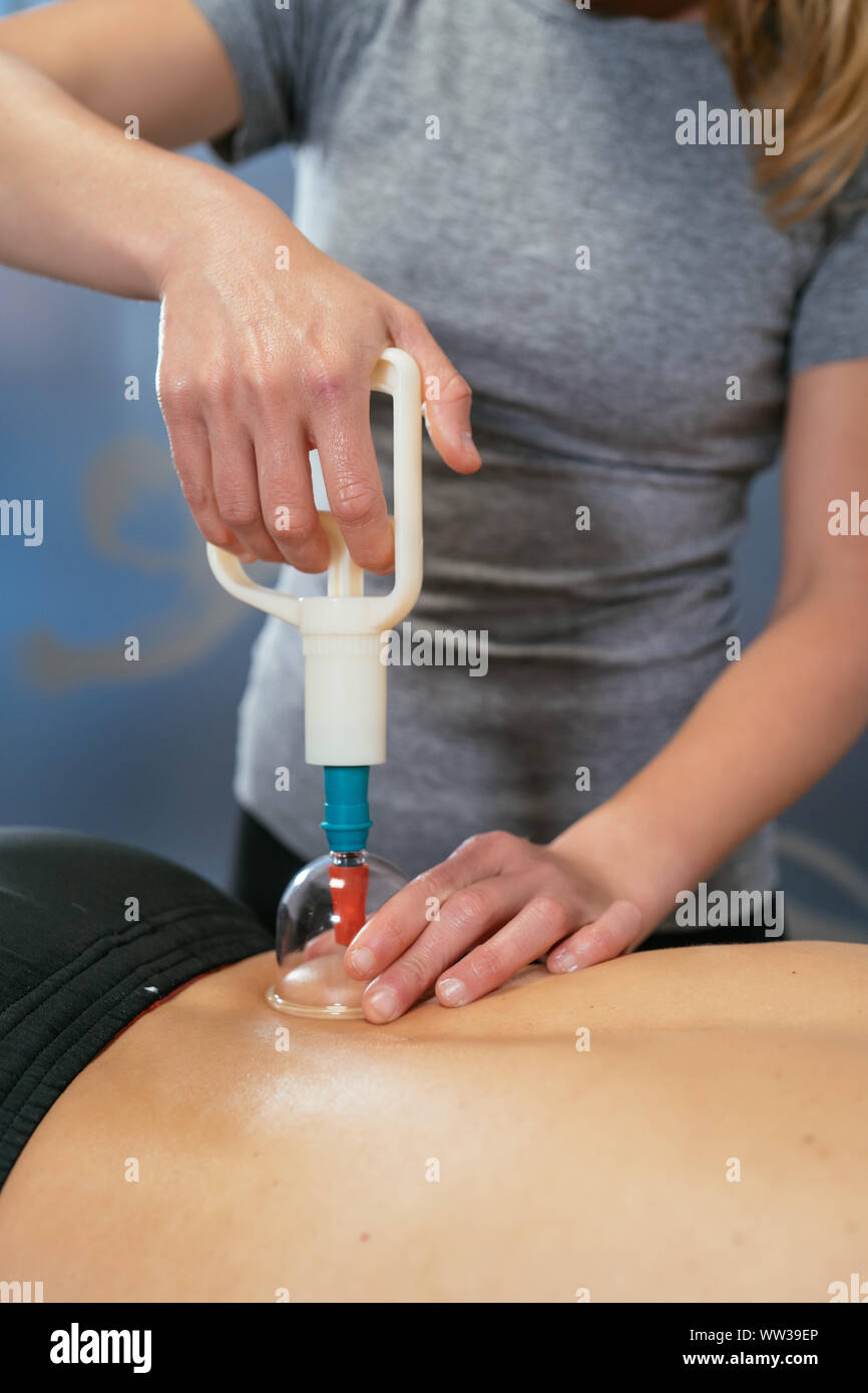 Physiotherapy With Suction Cups Detail Of A Physiotherapist Attaching A Suction Cup To A Patient S Back Vertical Image Stock Photo Alamy