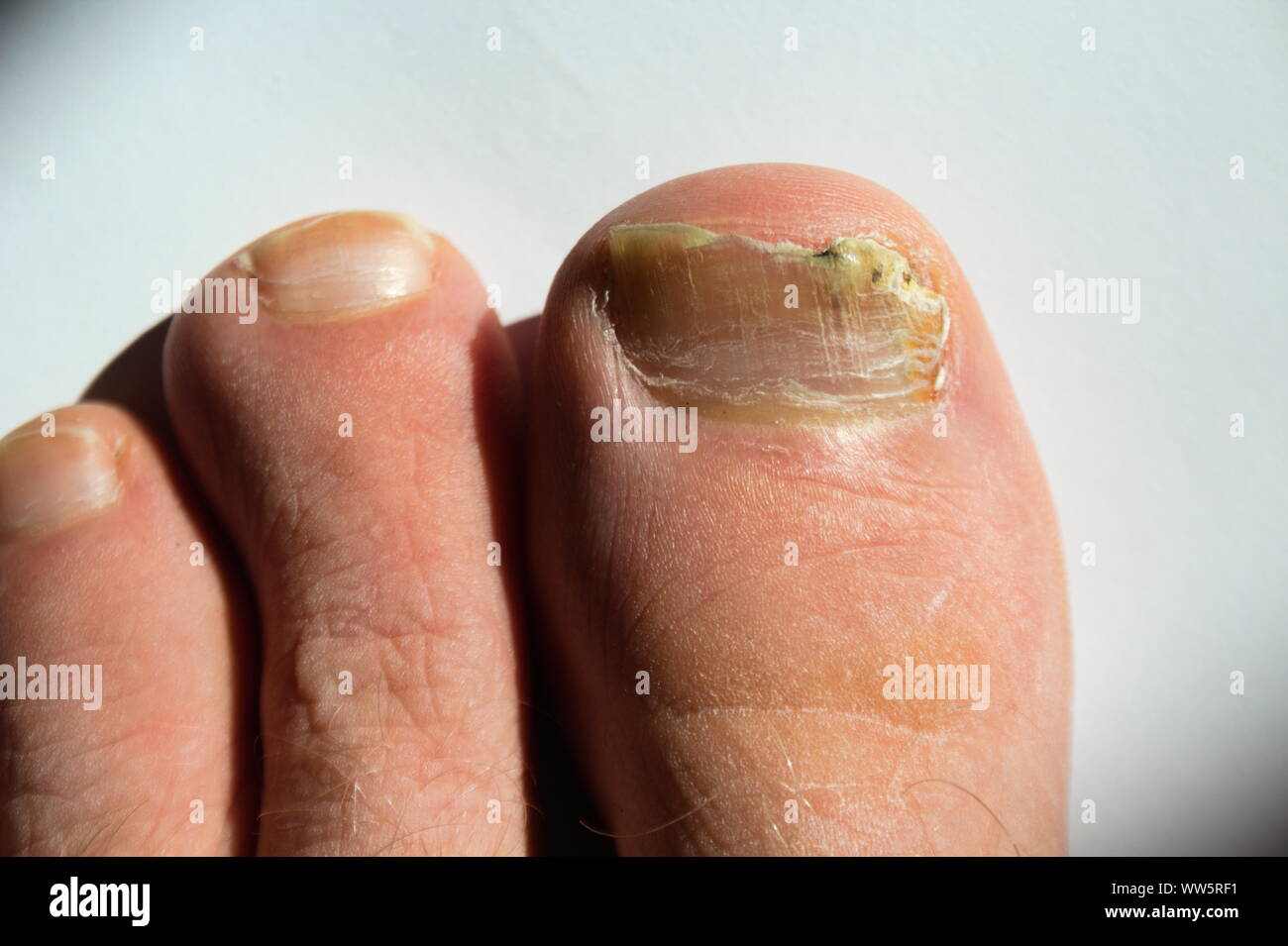 Fungal nail infection on big toe Stock Photo