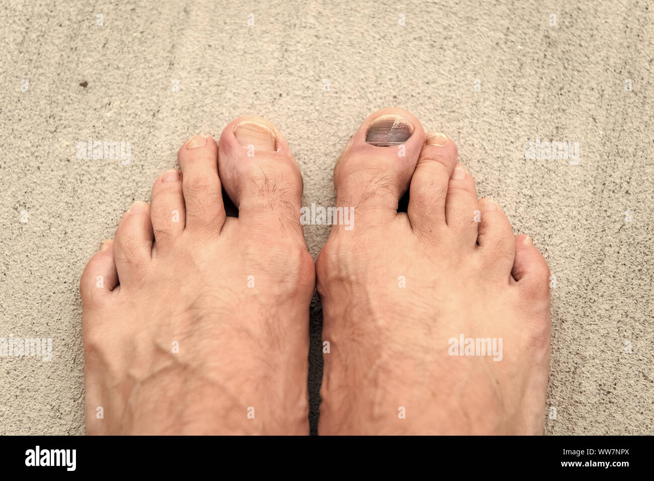 Take care of your feet. Pedicure and podiatry. Treatment of bruise and