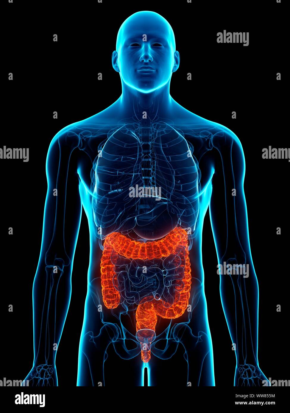 Damage Colon Diseased colon, conceptual illustration Stock Photo - Alamy