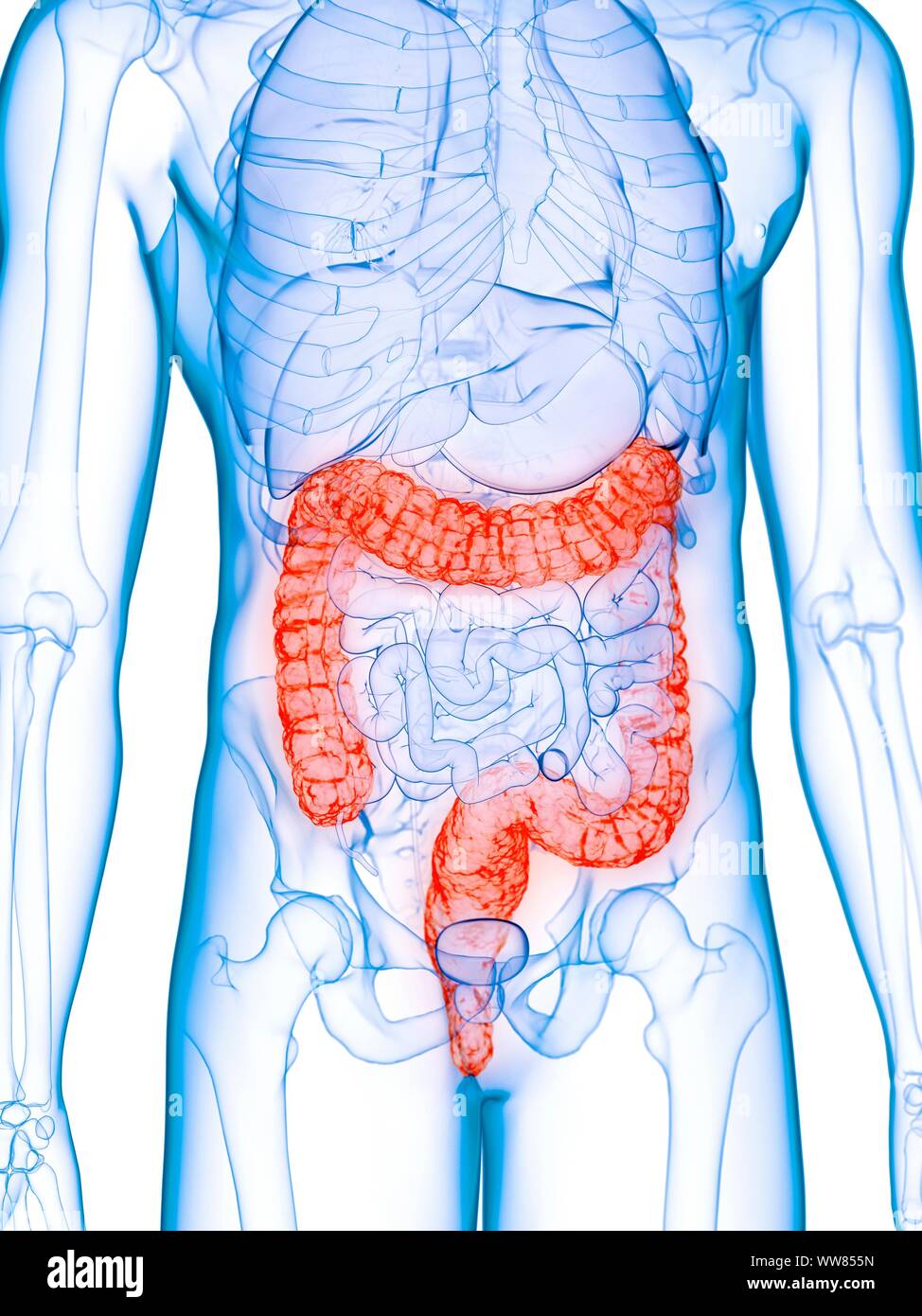 Damage Colon Diseased colon, conceptual illustration Stock Photo - Alamy
