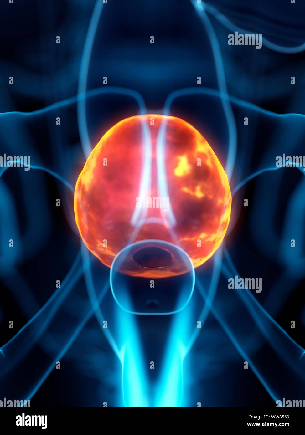 Diseased bladder, conceptual illustration Stock Photo - Alamy